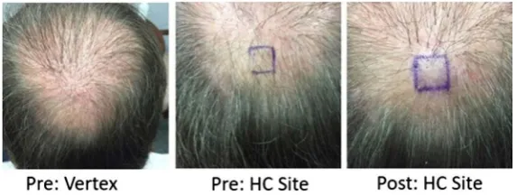 Figure 11. Subject 11: male age 75, Norwood type VI, four hair transplanatations (no hair count)
