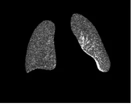 Figure 13: Case 3. Perfusion amplitude image obtained from anin the no-perfusion and reduced perfusion areas