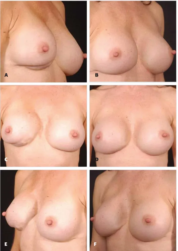 Figure 5. A, C, E, Preoperative views of a 40-year-old woman who had undergone multiple previous augmentation procedures