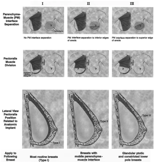Fig 8.  Extent of dissection at the parenchyma-muscle interface (above), the position of the inferior edge of divided pectoralis origins (center), and pectoralis position relative to the implant (below) for types I, II, and III dual plane augmentation tech