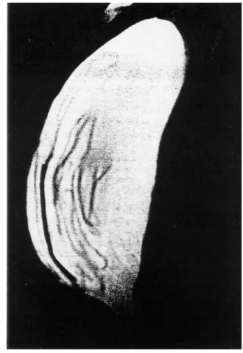 Fig 9.  MRI of implant rupture showing linguine sign.  (Reprinted with permission from Brown SL, Silverman BG, Berg WA:  Rupture of silicone-gel breast implants:  causes, sequelae, and diagnosis.