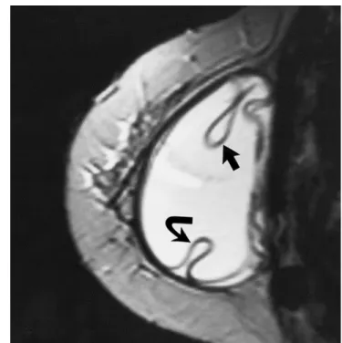 Fig 11.  Rupture of implant shell without complete collapse of the implant shell.  Teardrop signs (arrows) indicate silicone within a radial fold and outside the implant lumen itself.