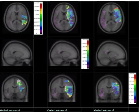 Figure 2. Image representation of 3 components aphasia ordinal model (left side image corresponds to right side of the patient, ra-diological conversion)