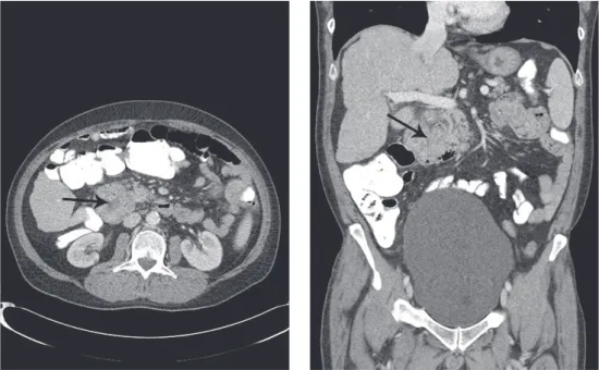 Figure 1: Axial and coronal CT of the abdomen demonstrating a 4.7 cm heterogeneously enhancing mass (arrow) involving the secondportion of the duodenum