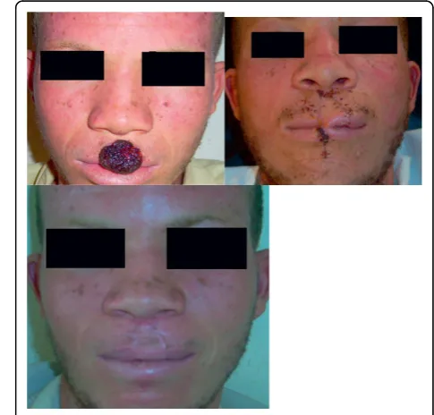 Figure 4 Patient No. 15: Multistaged tumour excision with cheek reconstruction.
