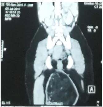 Figure 3. (a) CT of tumour, (b) MRI of tumour. 