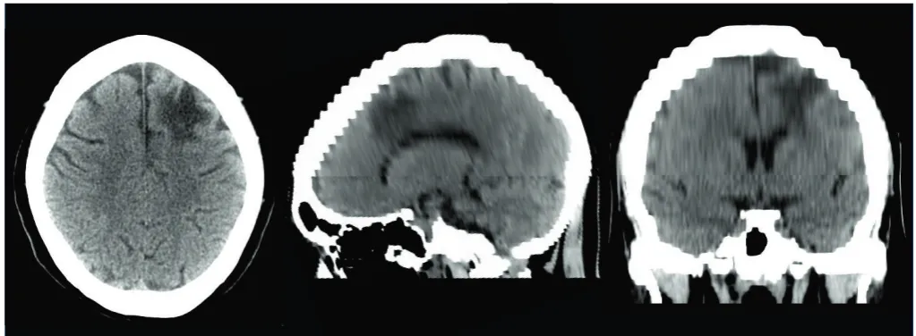 FIGURE 1. Computed Tomography (CT) imaging scan of head. It is clearly evident a large lesion in right frontal area.