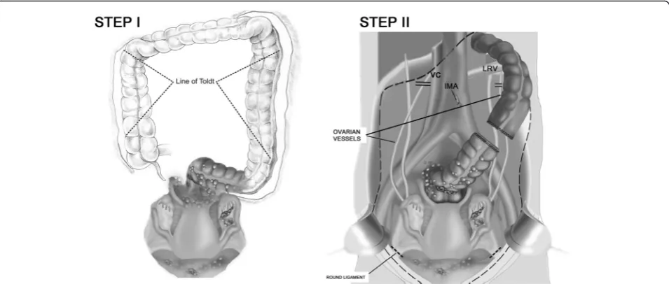 Fig. 1 The crucial steps of the proposed modification. a Entry into the extraperitoneal space and mobilization of the left and right colons