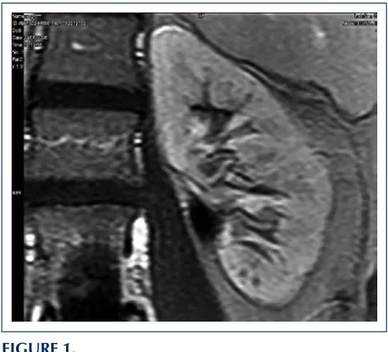 FIguRe 1. T1-weighted image of left kidney in a 53 y.o. female. After enhancement of the renal parenchyma with contrast material, renal microcysts (1-2 mm) appear as nonenhanced hypointense (dark) round structures in the lateral middle-upper pole and in th