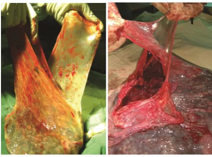 Figure 1. Peeling chorionic and amniotic membranes from each other in a placenta 
