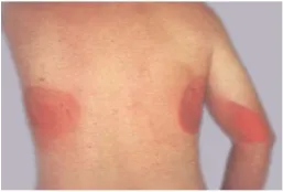 Figure 2: Some of the injuries caused by radioactive source [8]