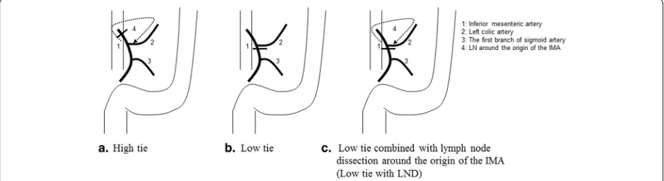 Fig. 1 Surgical technic schema of the two groups (a: High tie, b: Low tie, c: Low tie combined with lymph node dissection around the origin of the IMA)
