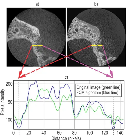 Fig. 3.  2D profile line measurement on a) original image, b) original image (green line) and after the improvement using FCM enhanced image, c) graph showing the intensity of pixels on (blue line)