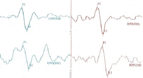 Fig. 1. Samples of cervical vestibular evoked in two groups (up: normal, down: rheumatoid arthritis patient)