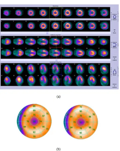 Fig 9. (a): short axis, vertical and horizontal long axis of SPECT image of a typical patient with pacemaker lead corrected for attenuation without MAR (top row) and with MAR (botom row)  (b): Bull's eye view of SPECT images corrected for attenuation witho