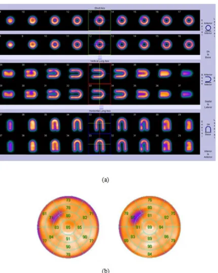 Figure 3 shows the CT images and µ-maps of the cardiac phantom with ICD lead, before and after applying MAR algorithm in association with artifact-free CT image and corresponding µ-map