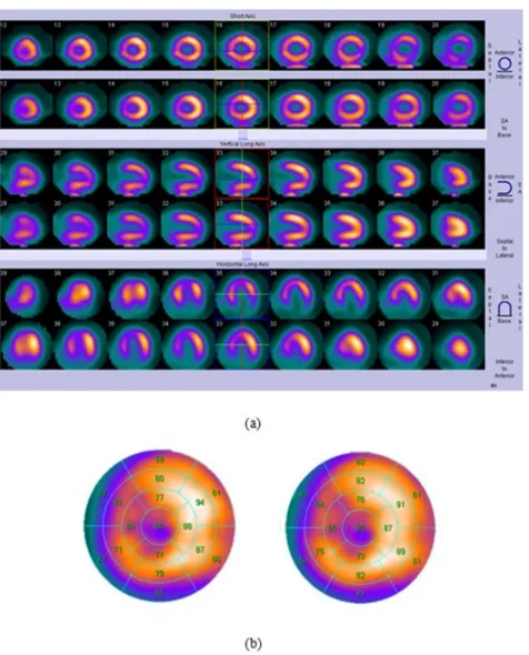 Fig 7. Typical transverse slice of patient with ICD lead, (a): CT image reconstructed without MAR, (b): CT image reconstructed with MAR, (c): difference image between CT images, (d): µ-map generated without MAR,(e): µ-map generated with MAR, (f): differenc