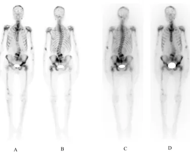 Fig 2. (A) Anterior and (B) posterior projections of the 99mTc-MDP bone scan of an 81 year old man with multiple bone metastases of prostate cancer