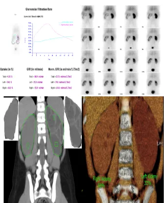 Table 1: Bland–Altman plot analysis values for comparisons between renal scan and CT in both obstructed and non obstructed kidneys