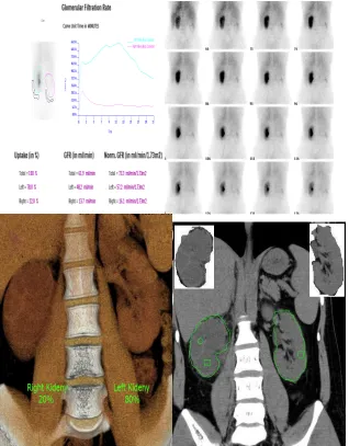 Fig 9. 59 year old male, presented with long standing right renal obstruction, with substantial low nephrons functions on renal scan (above), In volume estimation by CT (below) the individual renal function of the right kidney was 20% compared to 22 % in T