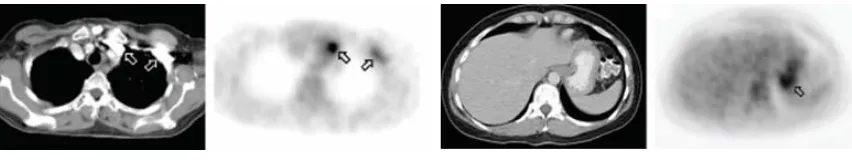 Figure 11. Original contrast enhanced CT image (a), segmented CT image (b), bone objects (c), contrast agent objects (d), original  contrast enhanced CT image after applying SCC to the regions segmented as containing contrast agent (e), generated μmap from