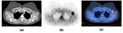 Figure 1: Transaxial slice from chest acquired with PET/CT.different modalities: (a) CT; (b) PET; and (c) hybrid  