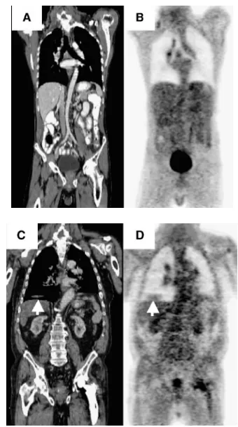 Figure 7. Effect of respiratory motion in CT propagates into the emission image through the attenuation correction