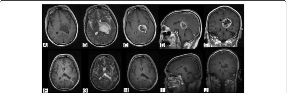 Fig. 4 Case 33. Cranial MRI examination revealed unilateral thalamus glioma located in the right thalamus and midbrain with mixed hypointenseand hyperintense (a) and hyperintense T2 (b) signals with clear enhancement (c–e)