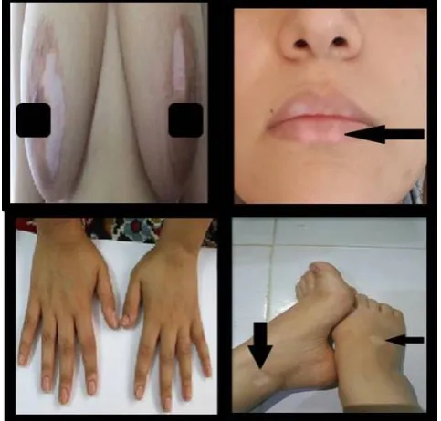 Figure 2. Presentations of the 20-year-old patient with vitiligo (case 1).  Depigmentation of the skin is evident on the lip, nails, breast and foot