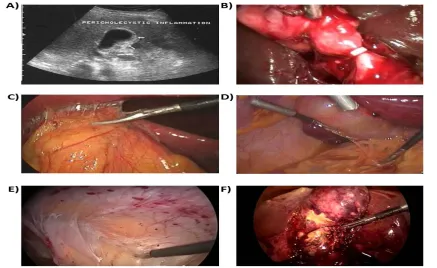 Figure 4. Clinical manifestations of some predictors of a difficult laparoscopic cholecystectomy