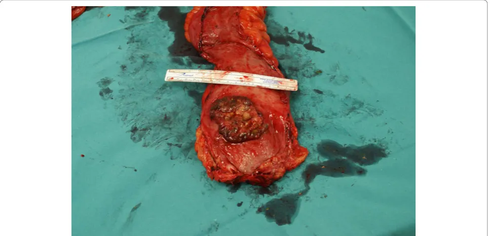 Figure 1 Total proctocolectomy specimen with ulcerative colitis and small cell carcinoma in the inferior part of the rectum.