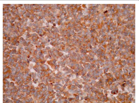 Figure 5 Small cell carcinoma in deeper invasion (H+E ×400)