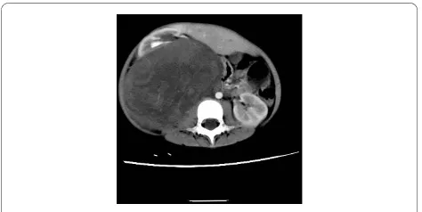 Figure 1 CT scan image of the tumor
