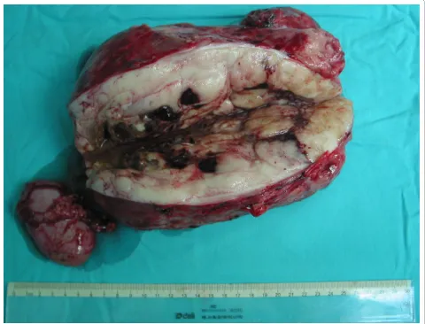 Figure 2 The tumor measured at 21 × 14.6 × 12.1 cm with intact capsule. The removed right kidney was next to the tumor