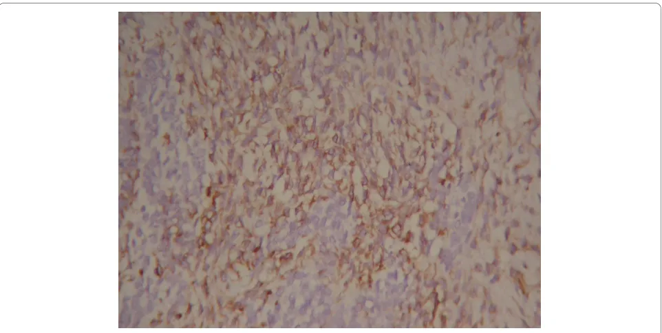 Figure 3 HE staining image of the tumor tissue. HE staining showed that the tumor tissue consisted of two well distinguished types of cells,large spindle cells lining in net with identifiable nuclear mitosis and epithelial nest or adenocarcinoma cells lining around microvascularstructure.