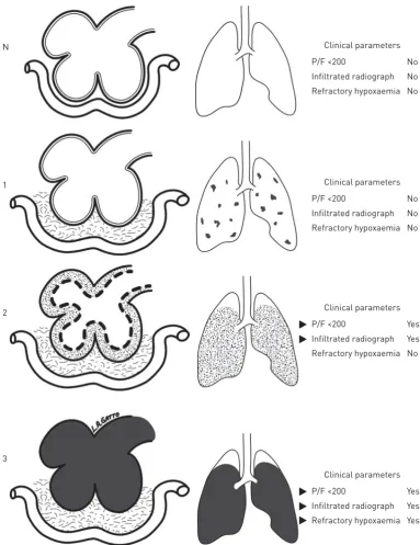 FIGURE 2 Pathogenesis of acute respiratory distress syndrome (ARDS); the left column represents thealveolar complex coupled with the interstitial space and capillary; the right column represents the lung