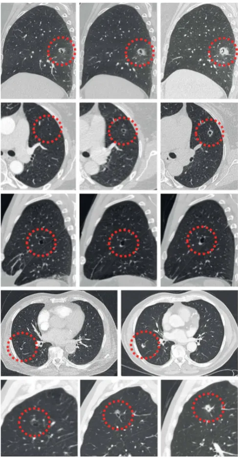 FIGURE 11 Evolution of cyst-related primary lung malignancies. Five different cyst-related primary lungmalignancies showing increase in solid components and progressive solidification over time (interval between5 months and 2.5 years)