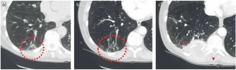 FIGURE 12 A change of lesion aspect should trigger action.lobe of a 67-year-old female was interpreted as nonspecific.increase in total size, more cystic and solid components as well as some ground glass, which did not triggerappropriate action