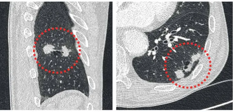 FIGURE 2 Morphological subtypes of cyst-related primary lung malignancies.component.circumferential wall thickening