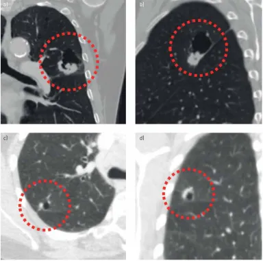 FIGURE 4 Classification of cyst-related primary lung malignancies may be prone to interobserver variation.small cell lung carcinoma in the left upper lobe