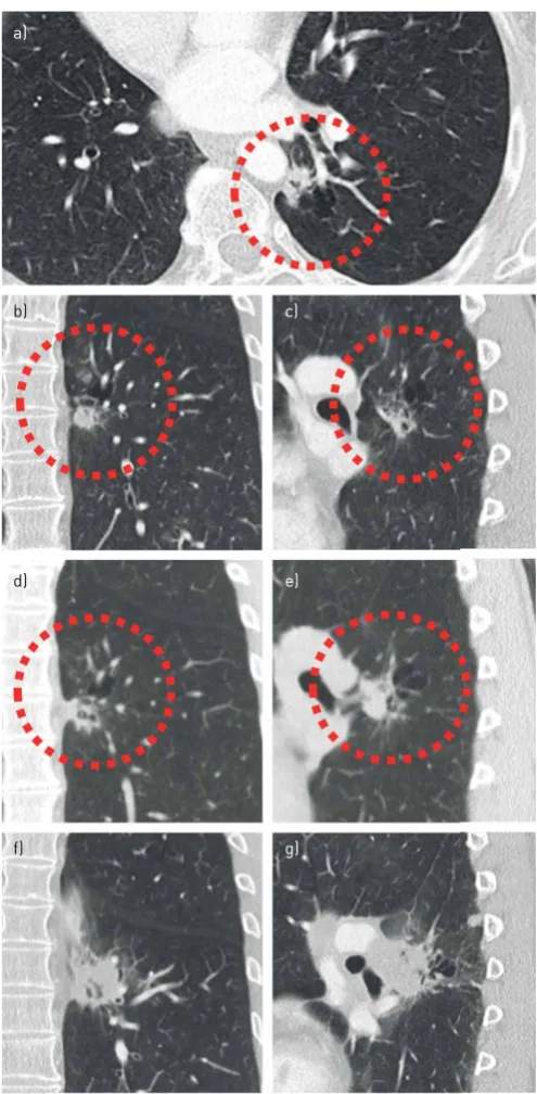 FIGURE 5 Failure to recognise cyst-related malignancies can lead to significant diagnostic delay