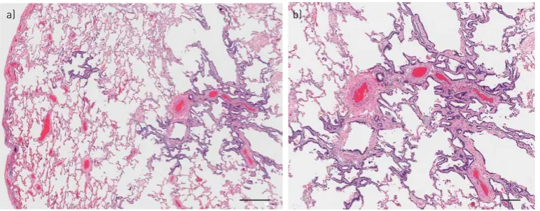 FIGURE 1 Bronchiolocentric fibrosis. a) This low power view shows fibrosis of peribronchiolar alveolar septa.Scalebar=500 µm.b)Ahigherpowerviewshowsperibronchiolarmetaplasiawithliningofthebronchiolocentric alveolar septa by ciliated columnar respiratory ep