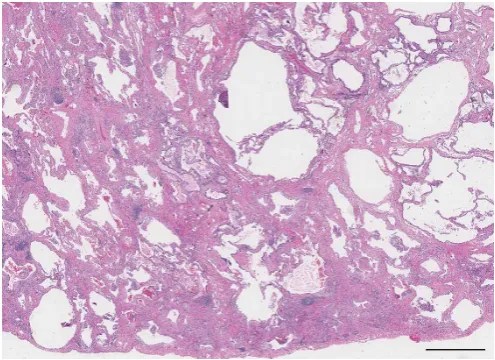 FIGURE 4 Unclassifiable interstitial fibrosis. This low power view shows patchy fibrosis with subpleural andbronchiolocentric accentuation as well as prominent lymphoid aggregates
