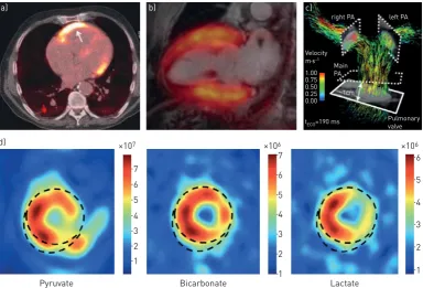 FIGURE 3 Non-invasive molecular imaging techniques may play a future role in the management ofpulmonaryhypertension.a)Positronemissiontomography–computedtomographyshowsincreased18F-fluorodeoxyglucose uptake in the right ventricular wall (arrow) in pulmonar