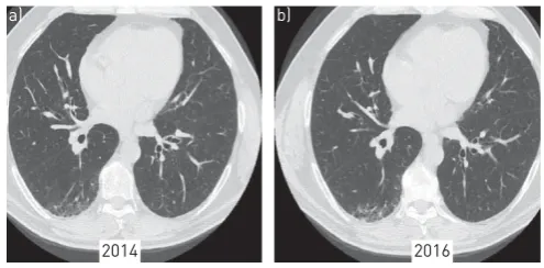 FIGURE 1 High-resolution computed tomography (HRCT) features of interstitial lung abnormalities