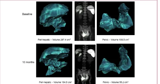 Figure 1 Case 2—volumetric MRI tumour measurements of perihepatic and pelvic mesothelioma demonstrating a 39% reduction in tumour volume after 10 months treatment with apitolisib.