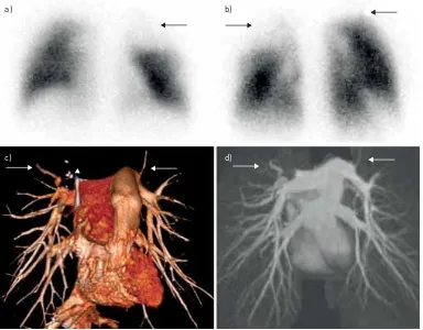 FIGURE 2 A 53-year-old patient with fibrosing mediastinitis. a) Anterior and b) posterior views from aperfusion scintigraphy scan show multiple segmental perfusion defects (arrows)