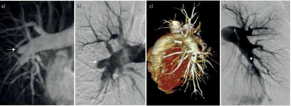 FIGURE 3 A 45-year-old with pulmonary hypertension.magnetic resonance pulmonary angiography confirm chronic thromboembolic pulmonary hypertension