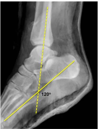Figure 1 Method of measurement of ankle neutrality on lateral radiograph.