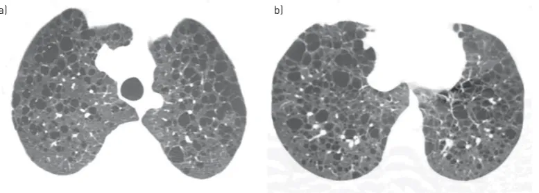 FIGURE 1 A 38-year-old woman with lymphangioleiomyomatosis. High-resolution computed tomographyscans of a) upper and b) lower lobes show multiple thin-walled cysts distributed symmetrically throughoutboth lungs, with normal intervening lung parenchyma.